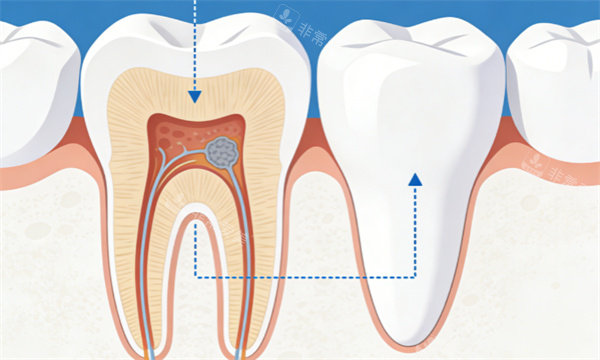 牙齿治疗通用插画示意图