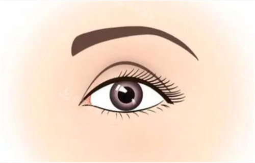 雙眼皮術(shù)后展示 雙眼皮術(shù)后展示