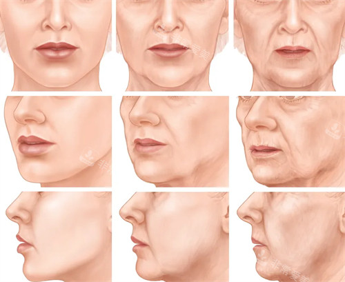 不同程度的法令纹 不同程度的法令纹