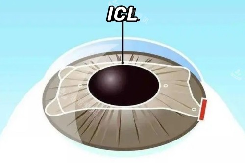 ICL晶体植入概念图