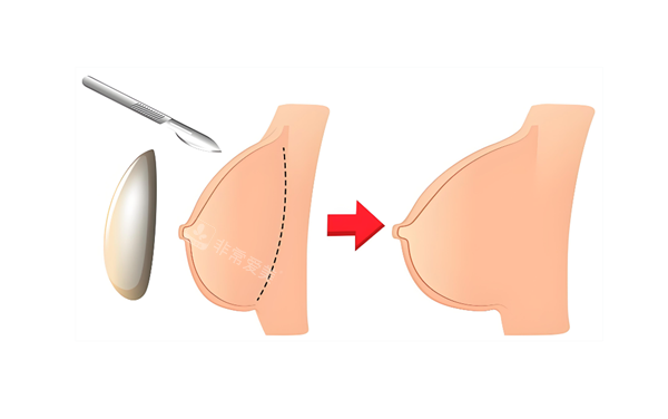 假体隆胸过程图 假体隆胸过程图