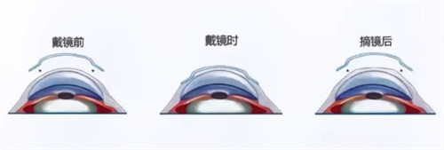角膜塑形镜佩戴