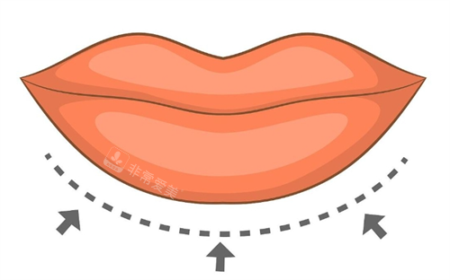 厚唇改薄画线示意图