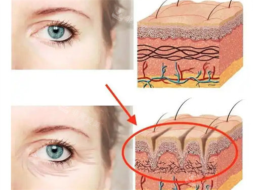 眼周筋膜提升前后