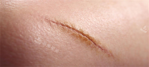 疤痕修复改善照片