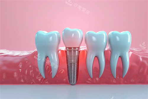 种植牙漫画模型解剖图