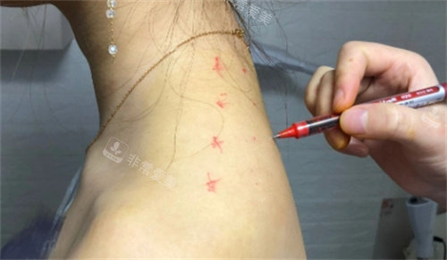 直角肩注射设计