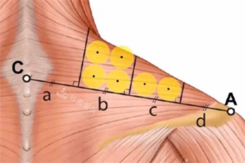 直角肩注射点位细节剖析