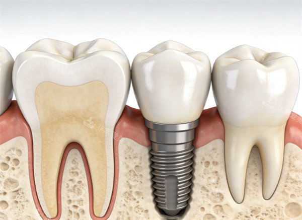 牙齿种植动画示意图