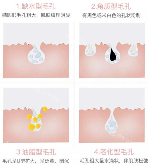 不同问题的毛孔 不同问题的毛孔