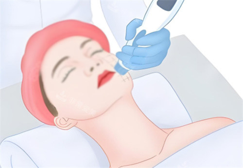 面部热玛吉 面部热玛吉