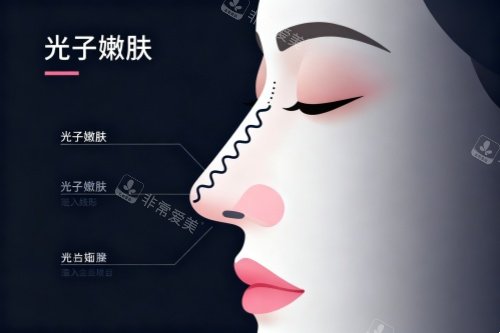 面部做光子嫩肤卡通图 面部做光子嫩肤卡通图