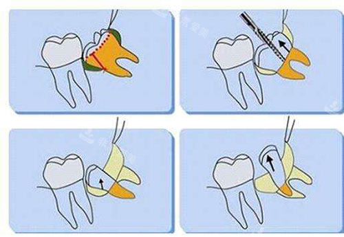 不同智齿类型实验题