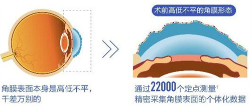 个性化飞秒术前