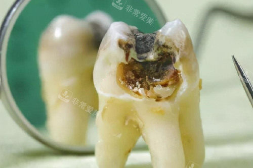 牙齿从根部开始烂图片