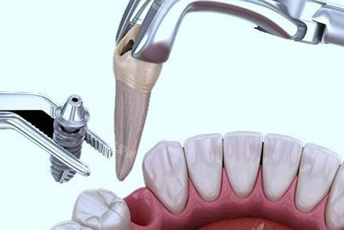 拔牙安装种植牙示意图