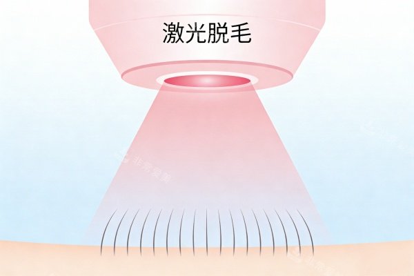 激光脱毛卡通图展示