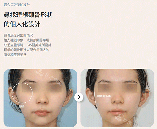 韩国345整形医院轮廓效果