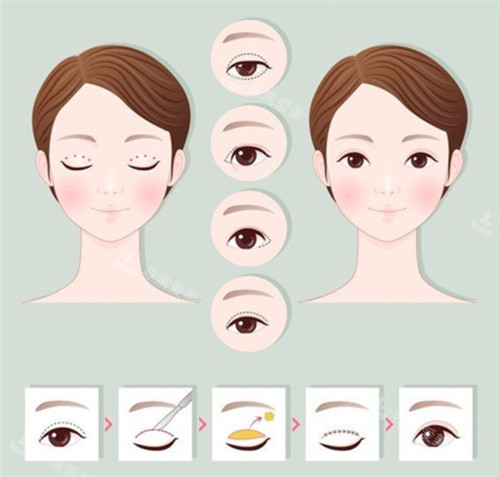 切開雙眼皮手術(shù)前后對(duì)比和過程 切開雙眼皮手術(shù)前后對(duì)比和過程