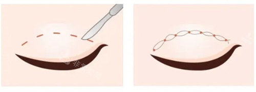 雙眼皮切開vs雙眼皮埋線 雙眼皮切開vs雙眼皮埋線