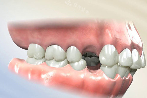 拔牙进行牙齿矫正示意图