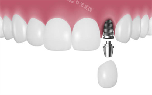 前牙区种植牙示意图
