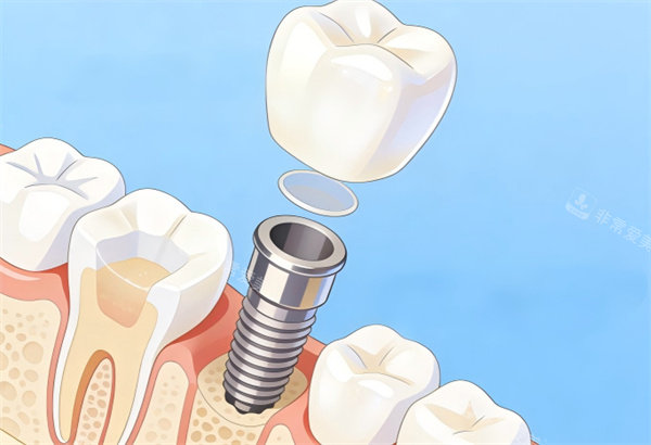 单颗种植牙卡通示意图