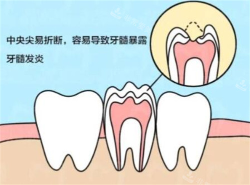 牙齿畸形中央尖有什么危害