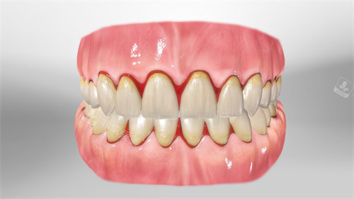 牙齿根部牙龈出血