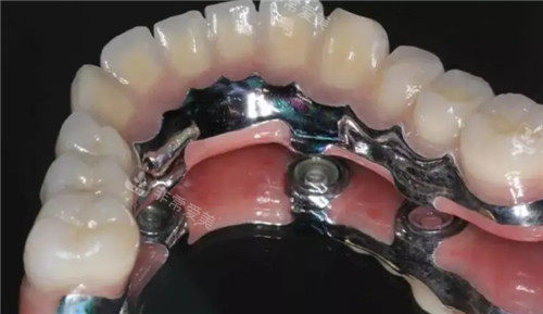 半口种植牙齿照片