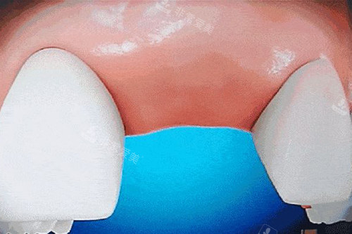 牙齿缺失卡通示意图