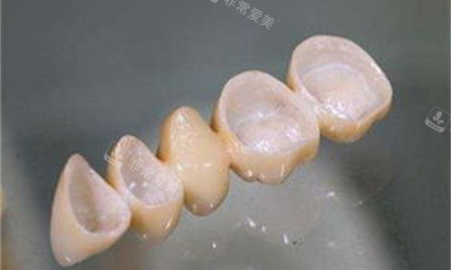 全瓷牙内冠展示图