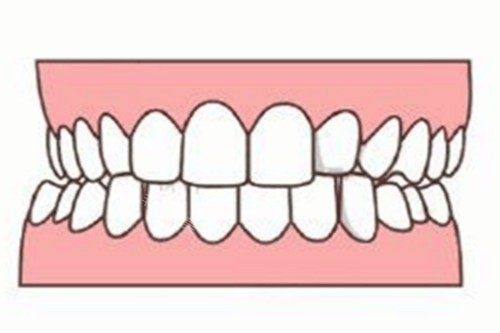 牙齿轻微畸形卡通图