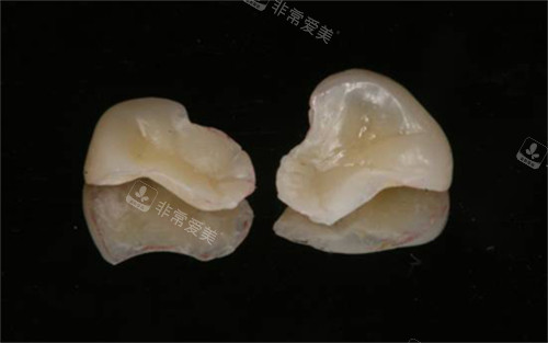 树脂嵌体实物展示图