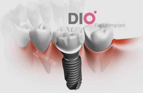 dio牙齿种植植体