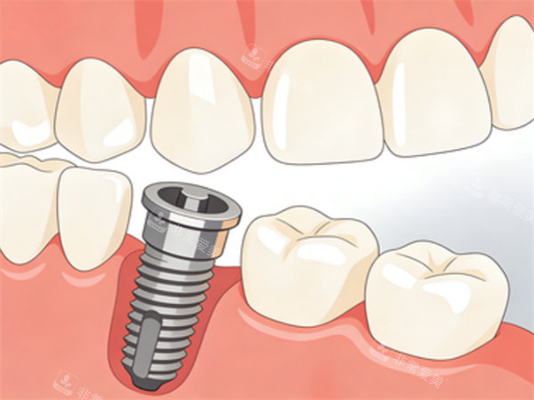 牙齿种植卡通展示图