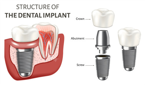 种植牙结构
