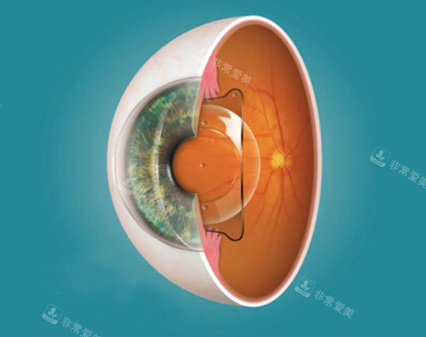 ICL手术细节分析图