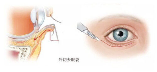 去眼袋切口图示