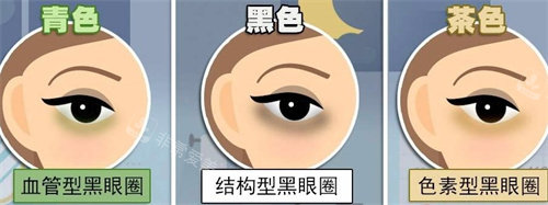 不同的黑眼圈类型 不同的黑眼圈类型