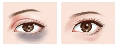 激光去黑眼圈对比 激光去黑眼圈对比