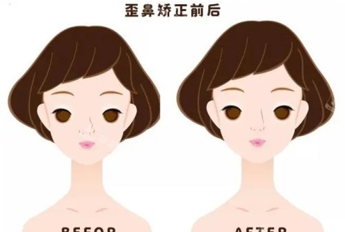 假体鼻子歪斜矫正前后示意图 假体鼻子歪斜矫正前后示意图