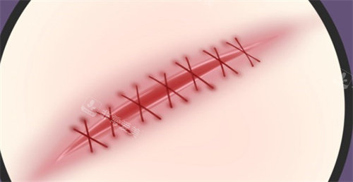 网评韩国祛疤痕医院排...