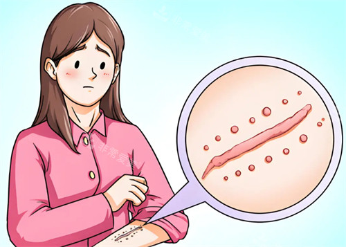 激光去疤能去掉手术疤痕吗 激光去疤能去掉手术疤痕吗