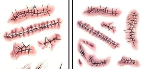 不同的手术疤痕 不同的手术疤痕