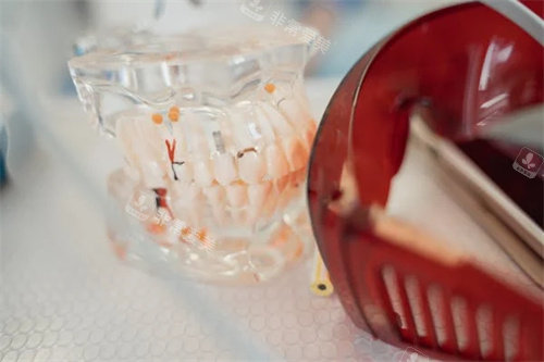 牙齿正畸示意图