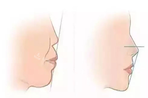 正畸前后侧脸对比示意图