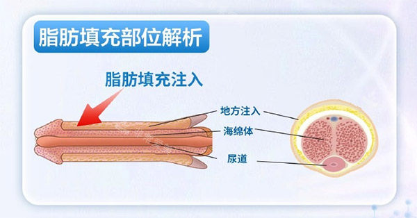脂肪增大增粗照片