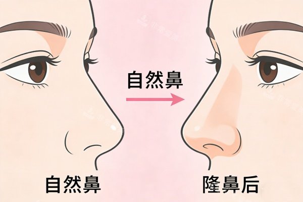 自然鼻型隆鼻前后对比图