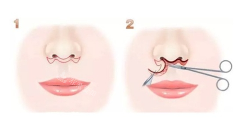 人中缩短术步骤过程